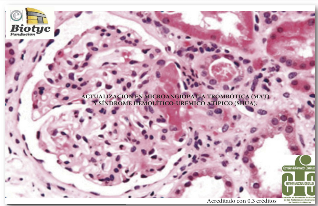 Actualización en Microangiopatía trombótica (MAT) y Síndrome Hemolítico-Urémico atípico (SHUa). 