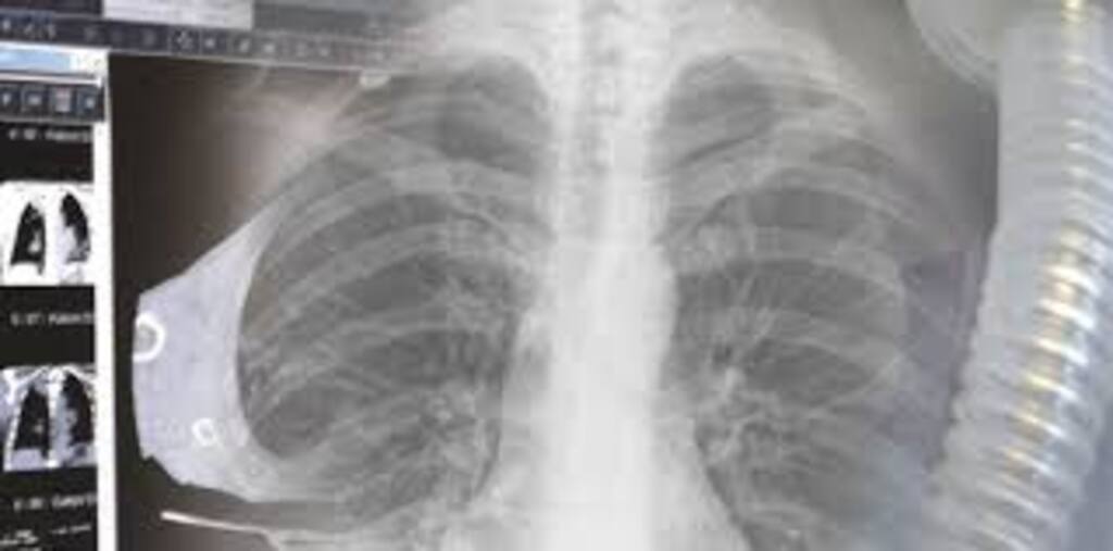Beca Consulta Monográfica de Neumología en Tumores Pulmonares: Abordaje Integral desde el Complejo Hospitalario Universitario de Albacete